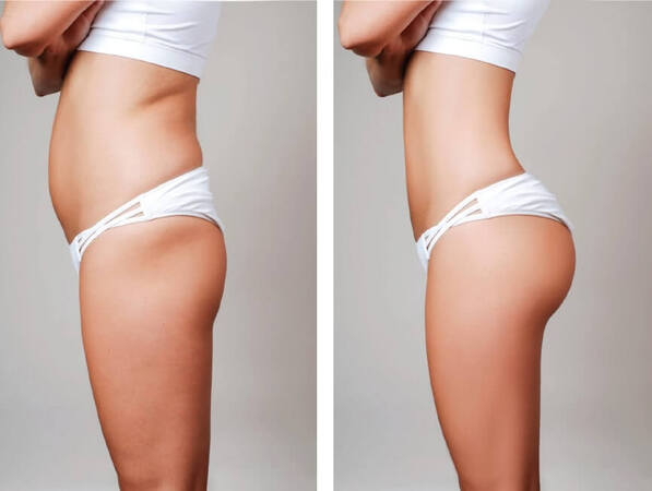 Vergleich von weiblichem Körper vor und nach einer Fettabsaugung am Bauch und Po.