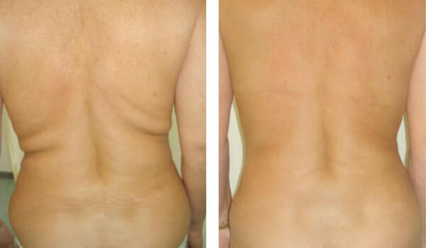 Vorher-nachher-Foto zeigt Rücken nach Fettabsaugung mit sichtbarer Hautstraffung.