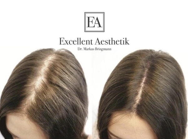 Vorher-nachher-Vergleich einer Haarverdichtung bei einer Frau von Excellent Aesthetik.