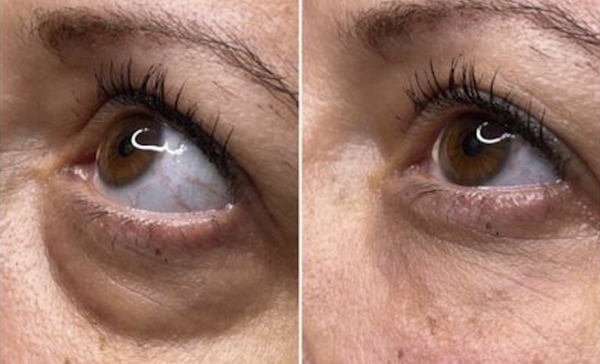 Vorher-nachher-Vergleich zur Reduktion von Augenringen und Falten unter dem Auge.