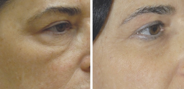 Vorher-nachher-Vergleich der Hautstraffung im Augenbereich zur Faltenbehandlung.