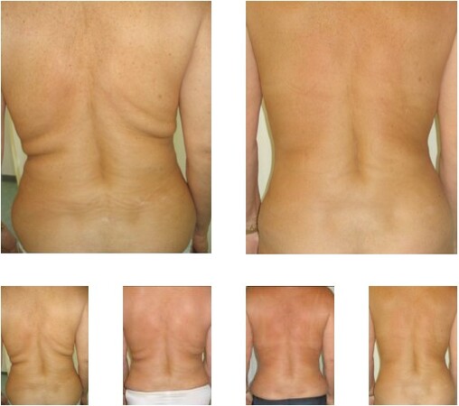 Vorher-nachher Vergleich der Rückenpartie nach einer Fettabsaugung am unteren Rücken.