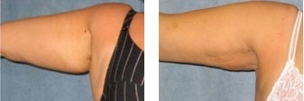 Vergleich von Oberarmen vor und nach einer Fettabsaugung zur Hautstraffung am Arm.