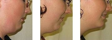 Drei Profilansichten zeigen den Vorher-Nachher-Effekt einer Doppelkinn-Entfernung.