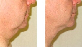 Vorher-nachher Vergleich Kinnstraffung zeigt Hautstraffung und Reduktion Doppelkinn.